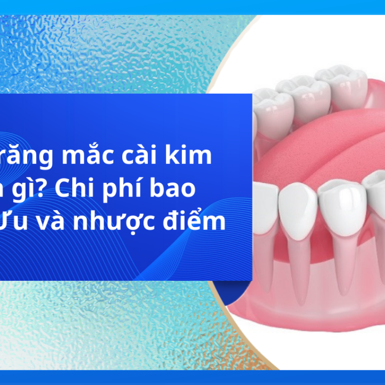 Niềng răng mắc cài kim loại là gì? Chi phí bao nhiêu? Ưu và nhược điểm