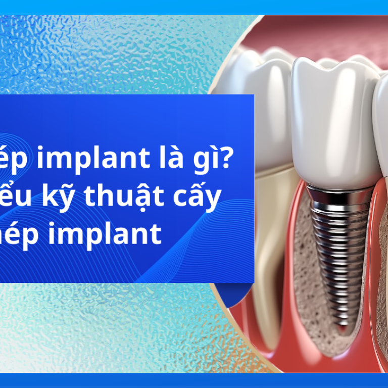 Cấy ghép implant là gì? Tìm hiểu kỹ thuật cấy ghép implant