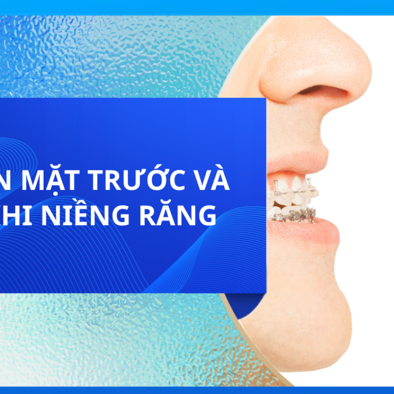 KHUÔN MẶT TRƯỚC VÀ SAU KHI NIỀNG RĂNG