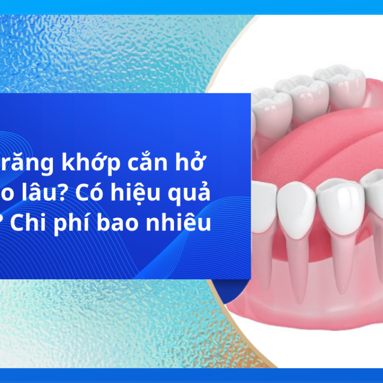 Niềng răng khớp cắn hở mất bao lâu? Có hiệu quả không? Chi phí bao nhiêu