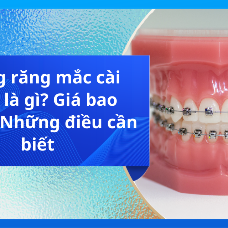 Niềng răng mắc cài titan là gì? Giá bao nhiêu? Những điều cần biết