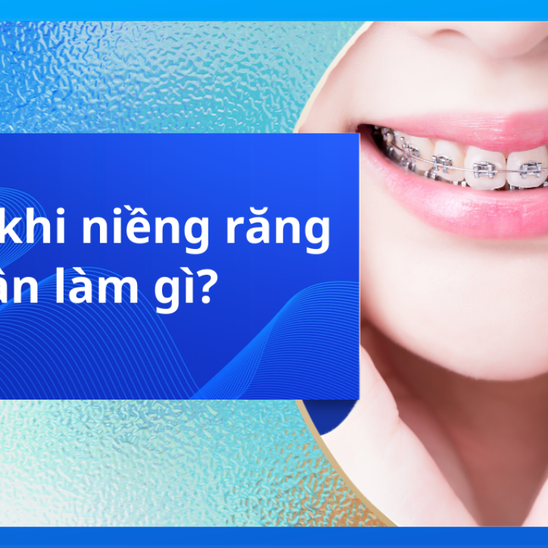 Trước khi niềng răng cần làm gì?