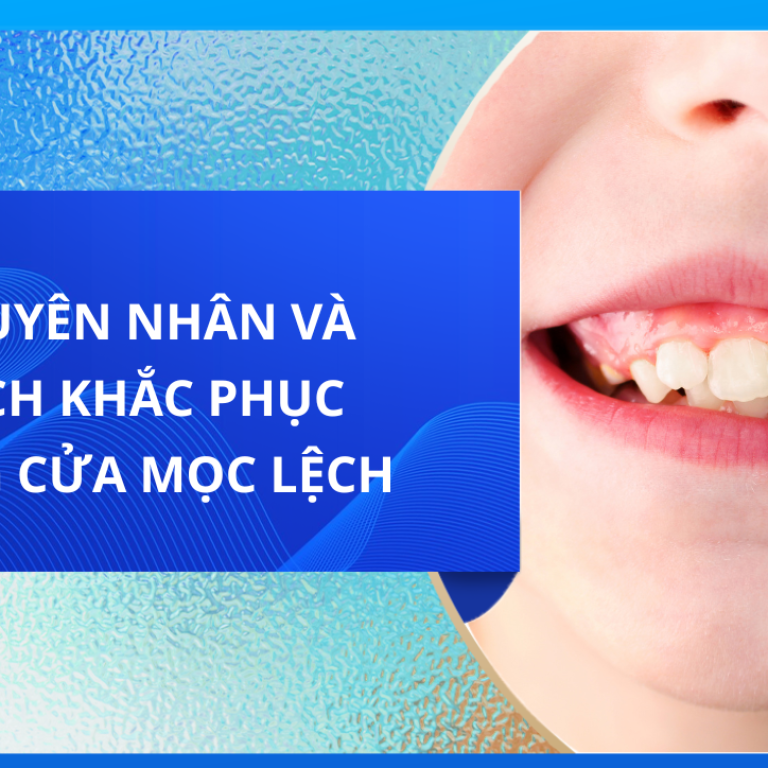NGUYÊN NHÂN VÀ CÁCH KHẮC PHỤC RĂNG CỬA MỌC LỆCH 