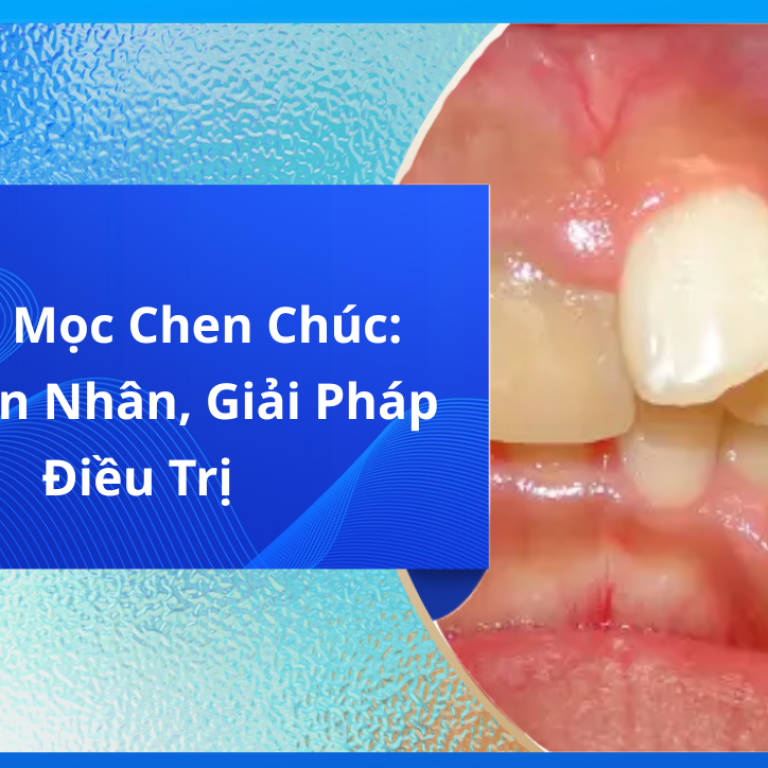 Răng Mọc Chen Chúc: Nguyên Nhân, Giải Pháp Điều Trị
