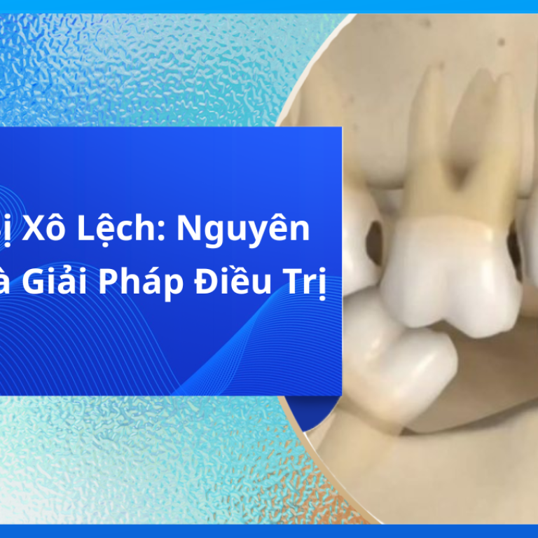 Răng Bị Xô Lệch: Nguyên Nhân Và Giải Pháp Điều Trị