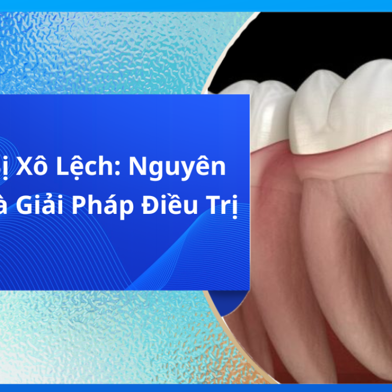Răng Nanh Mọc Ngầm Là Gì? Tìm Hiểu Chi Tiết
