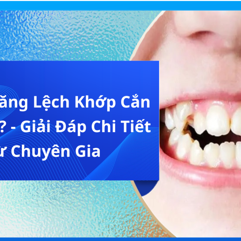 Niềng Răng Lệch Khớp Cắn Bao Lâu? - Giải Đáp Chi Tiết