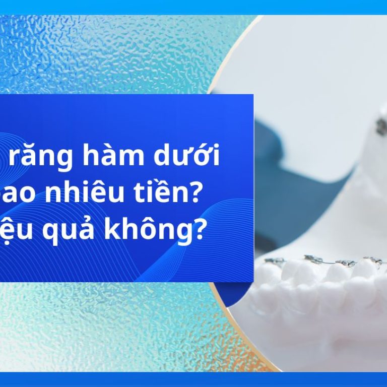 Niềng răng hàm dưới giá bao nhiêu tiền? Có hiệu quả không?