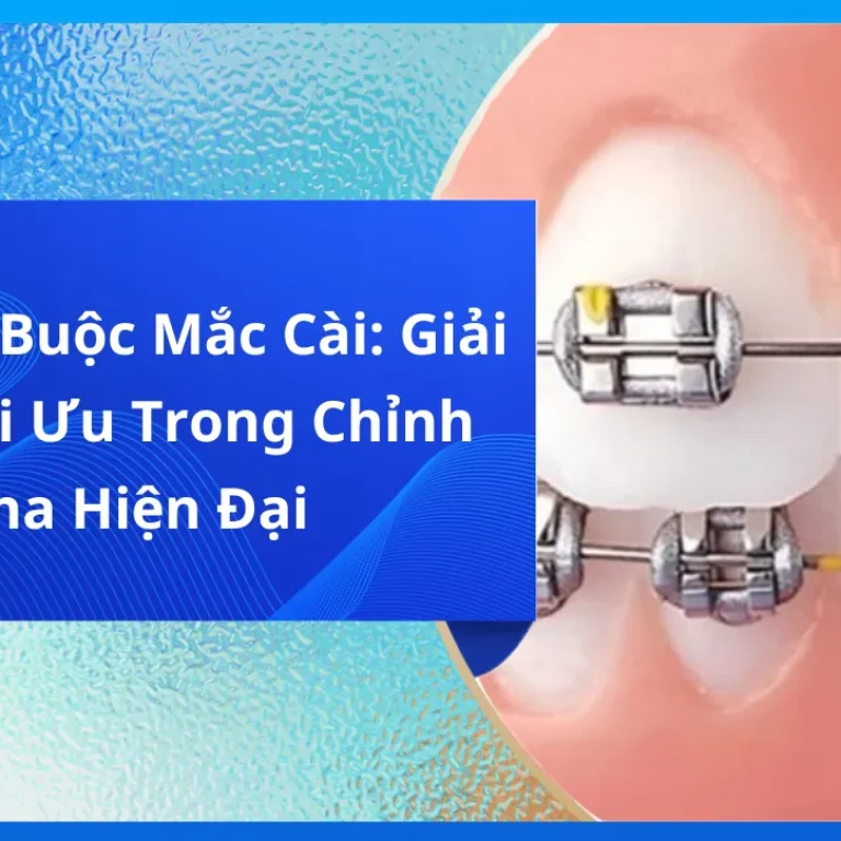 Chỉ Thép Buộc Mắc Cài: Giải Pháp Tối Ưu Trong Chỉnh Nha Hiện Đại