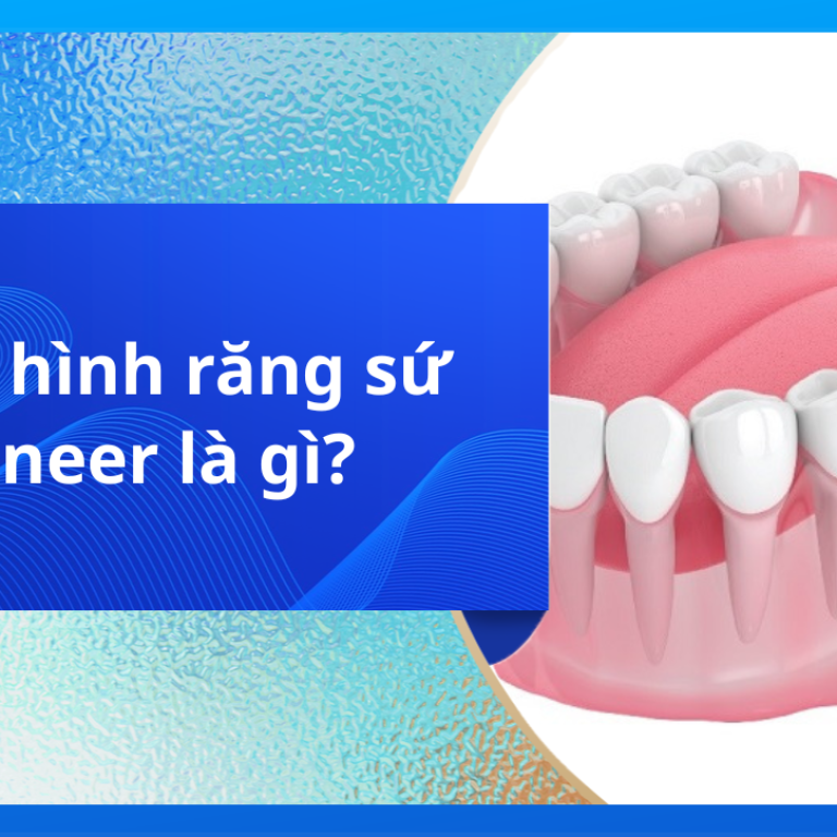 PHỤC HÌNH RĂNG SỨ VENEER LÀ GÌ?