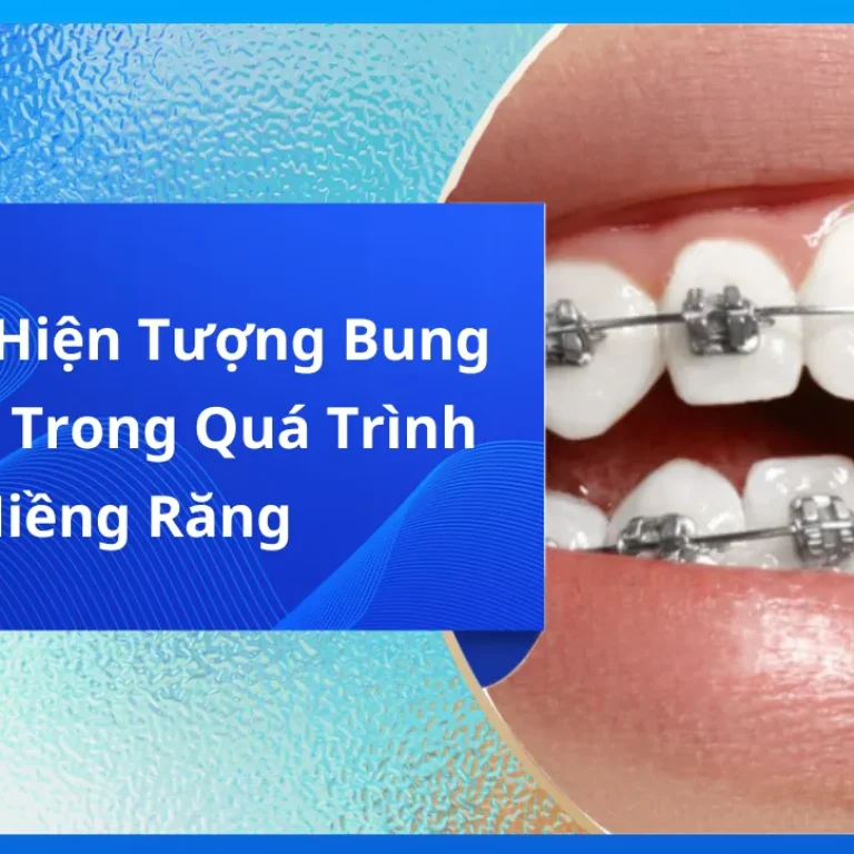 Giải Mã Hiện Tượng Bung Mắc Cài Trong Quá Trình Niềng Răng