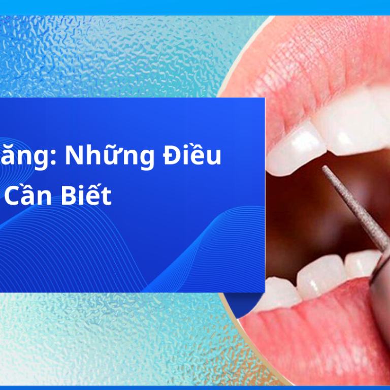 Cắt Kẽ Răng: Những Điều Cần Biết