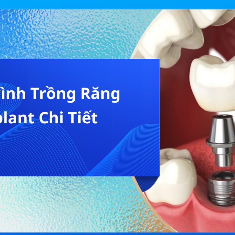 Quy trình trồng răng implant chi tiết
