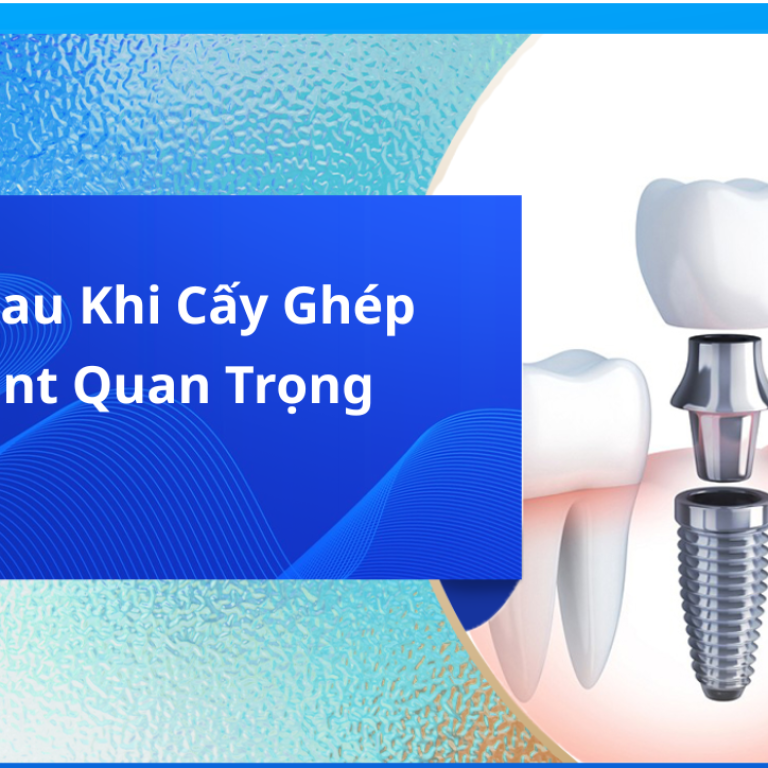 Lưu ý sau khi cấy ghép Implant