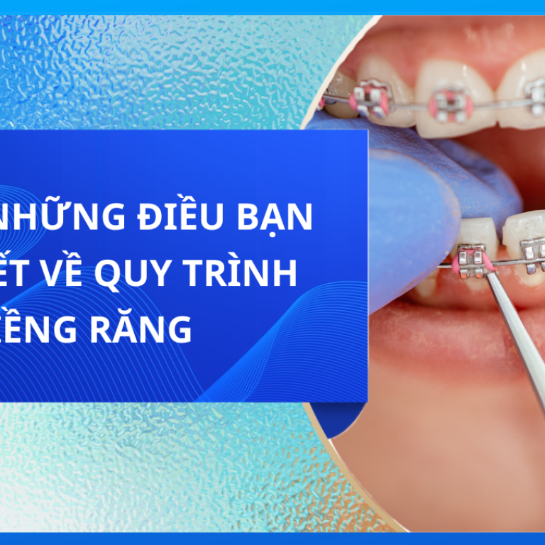 TẤT CẢ NHỮNG ĐIỀU BẠN CẦN BIẾT VỀ QUY TRÌNH NIỀNG RĂNG