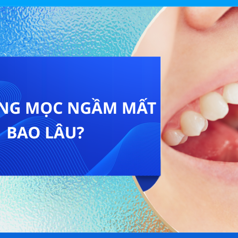 Kéo răng mọc ngầm mất bao lâu?