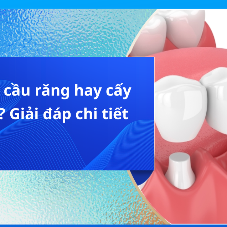 Nên làm cầu răng hay cấy implant?
