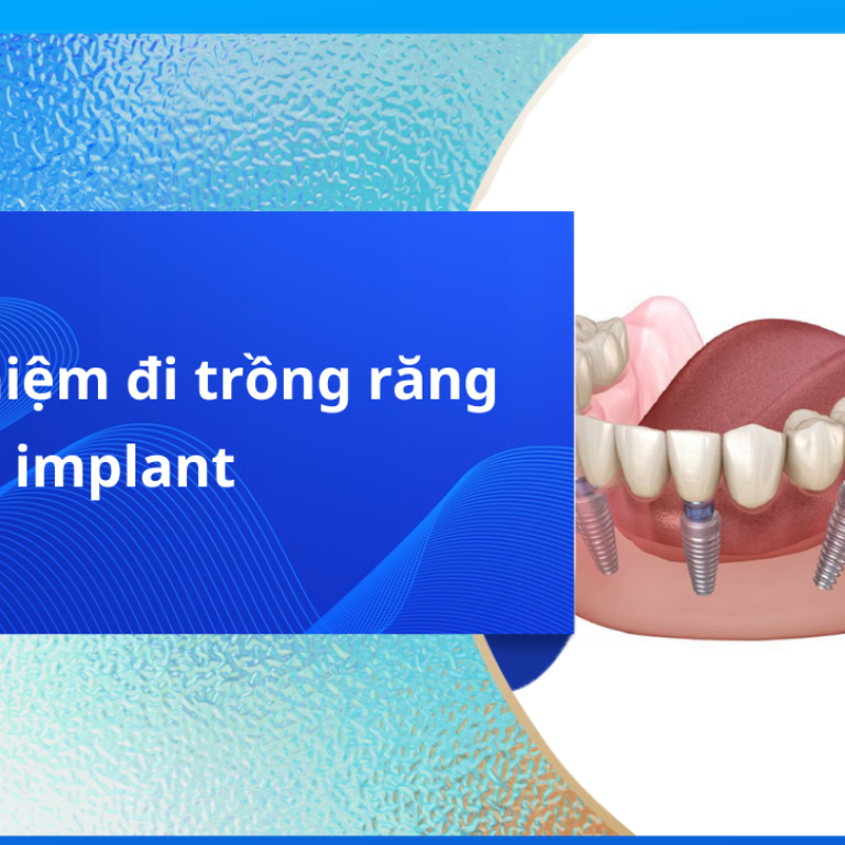 Review thực tế 7 kinh nghiệm đi trồng răng Implant