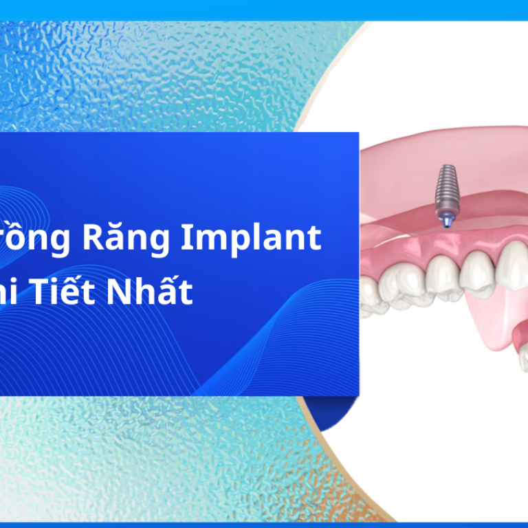 REVIEW TRỒNG RĂNG IMPLANT NGUYÊN HÀM
