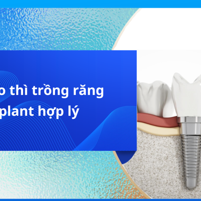 Khi nào thì trồng răng implant? Tìm hiểu chi tiết
