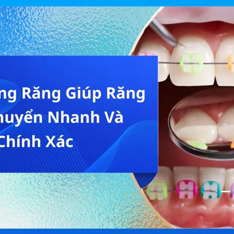 Lò Xo Niềng Răng Giúp Răng Dịch Chuyển Nhanh Và Chính Xác