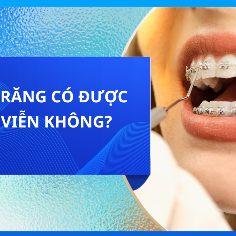NIỀNG RĂNG CÓ ĐƯỢC VĨNH VIỄN KHÔNG?